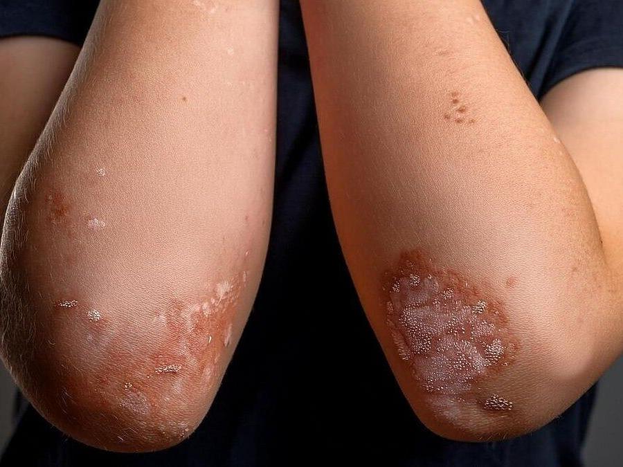 Divorce, Separation Might Increase Kids' Risk Of Psoriasis